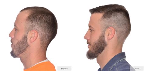 August Featured Client Amazing 8 Month ARTAS Robotic FUE Hair