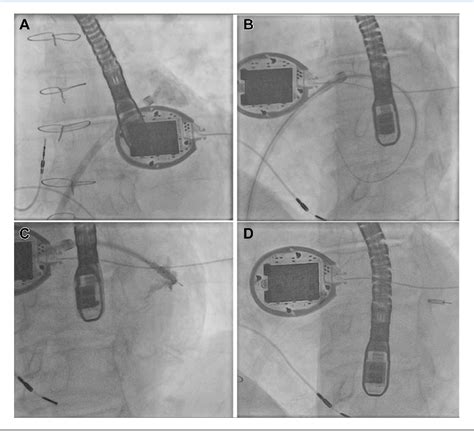 Figure From Transseptal Delivery Of A Leadless Left Ventricular