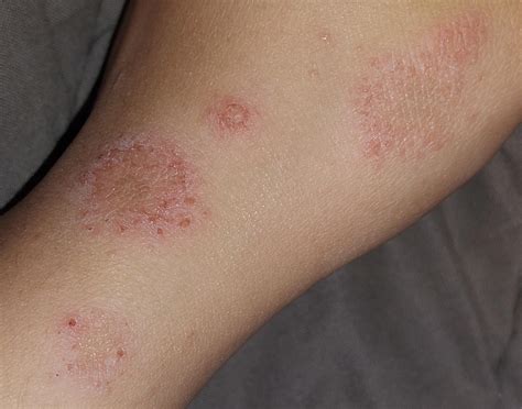 Ringworm Or Eczema Please Help Me Rmedicaladvice