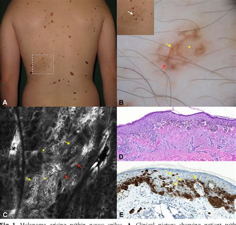 Figure From Determina O Dos Padr Es Da Microscopia Confocal In Vivo