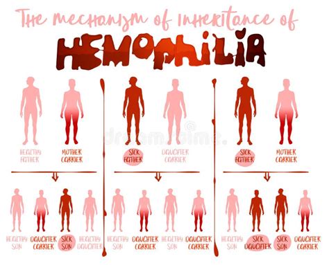 Hemofilii Dziedziczenie Ilustracji Ilustracja Złożonej Z Krew 52018482