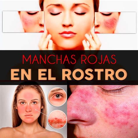 Manchas Rojas En La Cara Causas Y Tratamiento La Gu A De Las Vitaminas