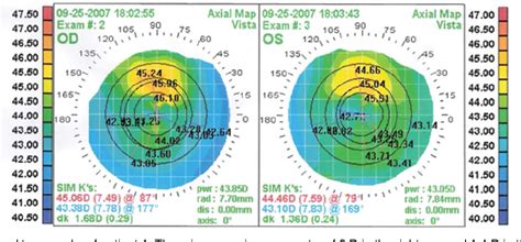 Map Dot Fingerprint Dystrophy