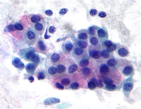 Pathology Outlines Mucoepidermoid Carcinoma