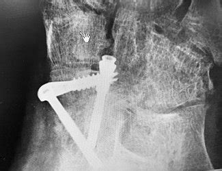 Talonavicular Joint Fusion