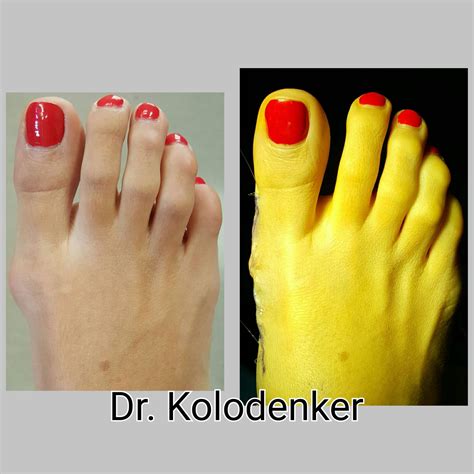 Bunion Surgery - OC Podiatry