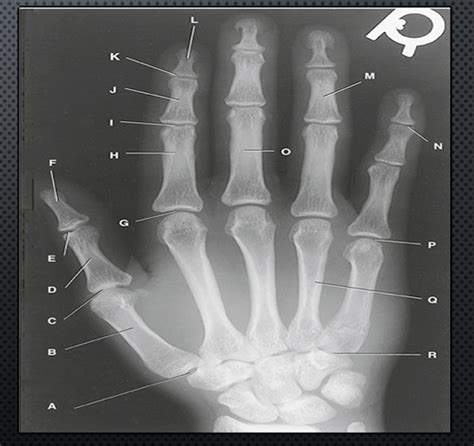 Rad Proc 1 Ch 4 Upper Limb Branson Flashcards Quizlet