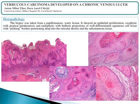 PPT - Introduction Verrucous carcinoma is a form of well-differentiated squamous cell carcinoma ...