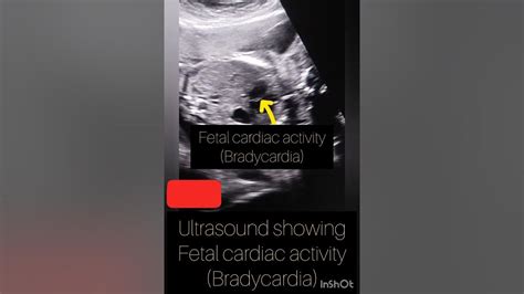 Ultrasound Showing Fetal Heartfetal Bradycardia On Ultrasound Pregnancy Ultrasound