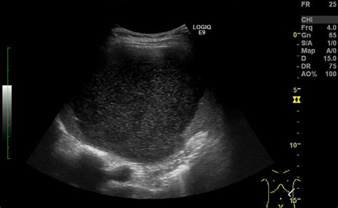 Ultrasound Showing A Unilocular Cyst With Multiple Mobile Internal Download Scientific Diagram