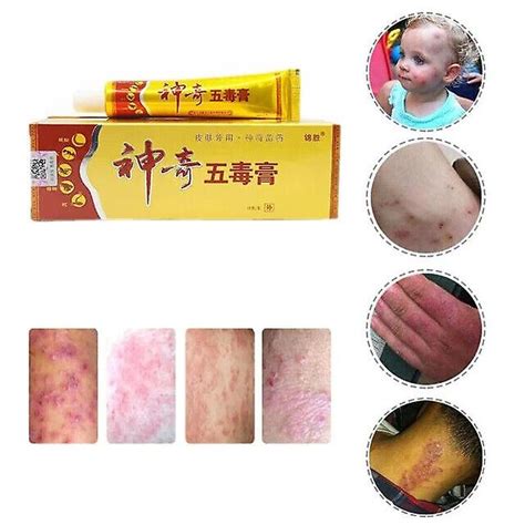 Skin Psoriasis Cream Dermatitis Eczematoid Eczema Ointment Scalp Treatment Fruugo Uk