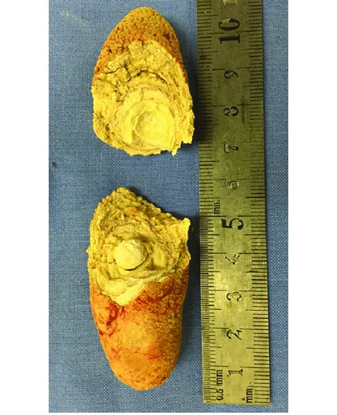 The removed sialolith after dissection to show the internal laminated ...