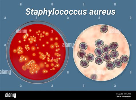 Staphylococcus aureus bacteria, illustration Stock Photo - Alamy