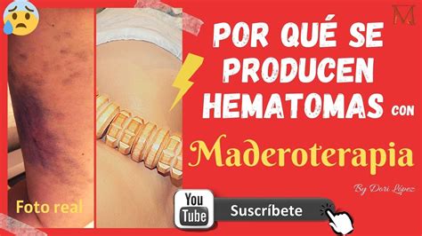 Por Qu Se Producen Hematomas Con Maderoterapia By Dori L Pez Youtube