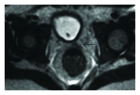 Voiding Cystourethrography Magnetic Resonance Imaging And