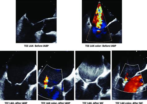 A B Transoesophageal Echocardiography Long Axis View With And Download Scientific Diagram