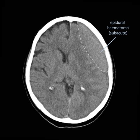 Head And Spine Pathology Radiology Cafe