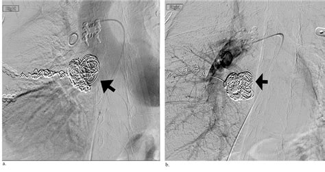 Figure 1 From Isolated Common Iliac Aneurysm And Spontaneous Ilioiliac