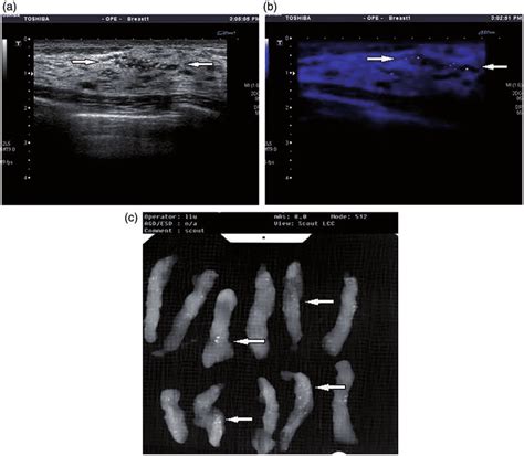 Ultrasound Guided Vacuum Assisted Breast Biopsy A Breast