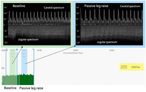 Continuous Venous Arterial Doppler Ultrasound During A Preload Challenge Scientific Article