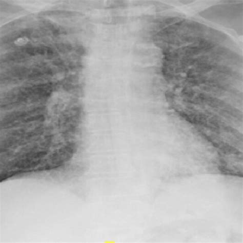 Chest Radiograph Postero Anterior View At Admission Showing Bilateral