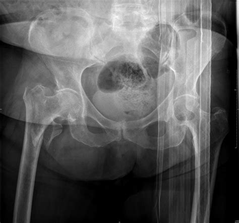 Fracture Du Massif Trochanterien Intervention Sur Les Traumatologies