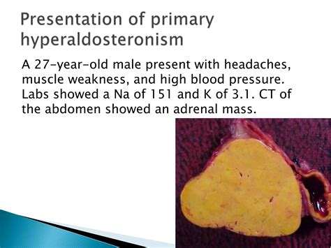 Disease Of Adrenal Gland Ppt