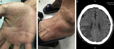 Embolic Origin of Osler Nodes - Mayo Clinic Proceedings