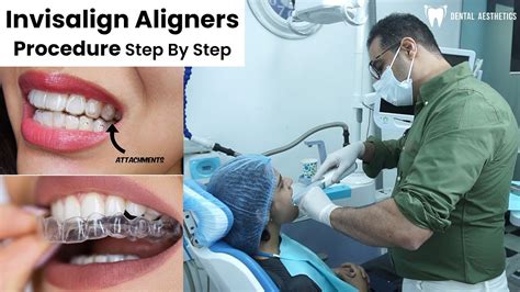 Invisalign Aligners Procedure Step By Step Explained Including