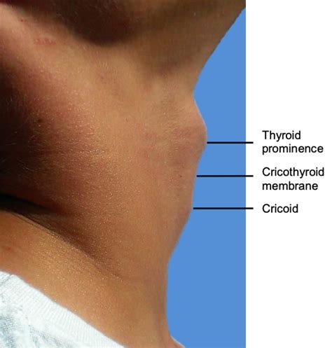 1.27: Cricothyroidotomy and Needle Cricothyrotomy - Medicine LibreTexts