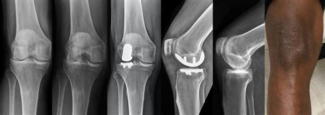 Partial Knee Replacement