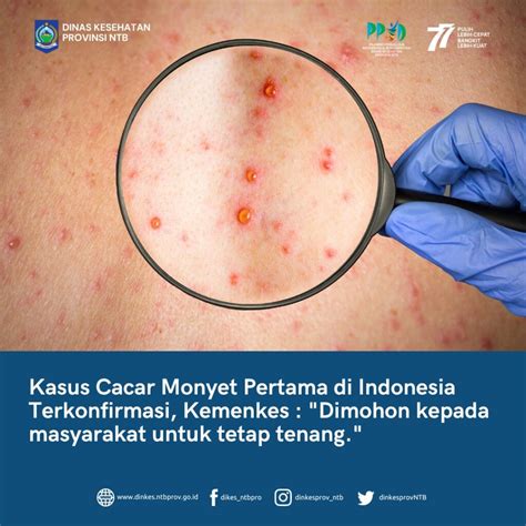 Kasus Cacar Monyet Pertama Di Indonesia Terkonfirmasi Kemenkes Minta