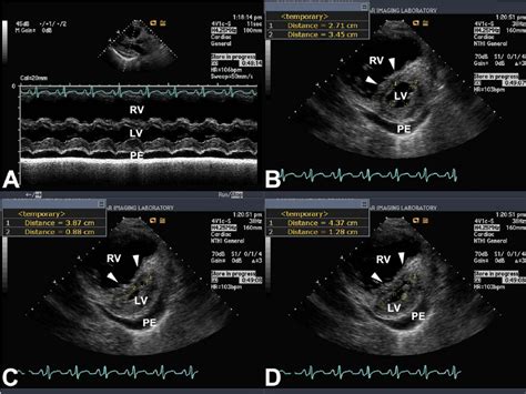 Eccentricity Index A M Mode At The Level Of Lv Papillary Muscles In