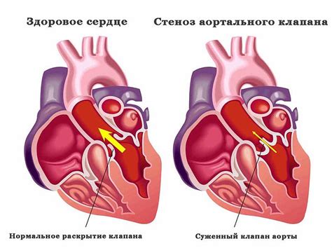 Кардиохирургия в Германии: Аортальный клапан: строение, заболевания ...