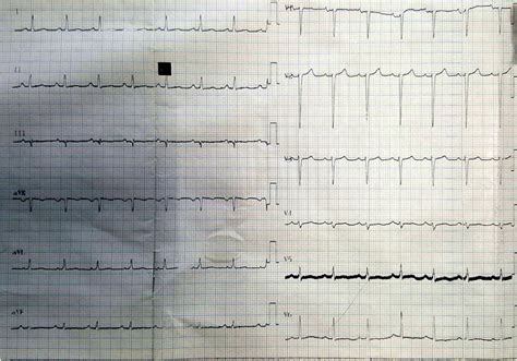 Electrocardiography Showed Normal Sinus Rhythm With Beats Per Minute