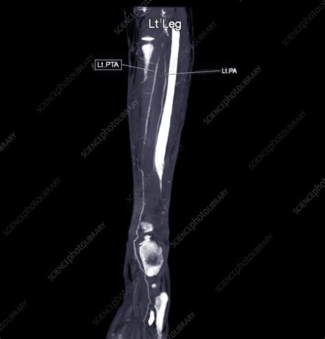 Femoral artery, CT scan - Stock Image - F037/5586 - Science Photo Library