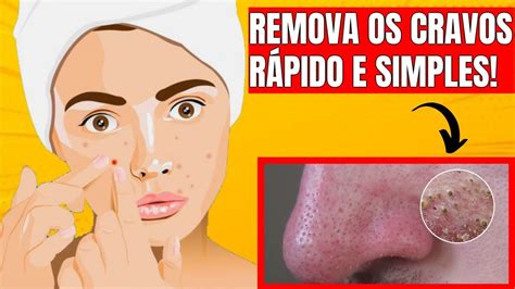 Como REMOVER CRAVOS do ROSTO essa RECEITA SIMPLES E FÁCIL YouTube