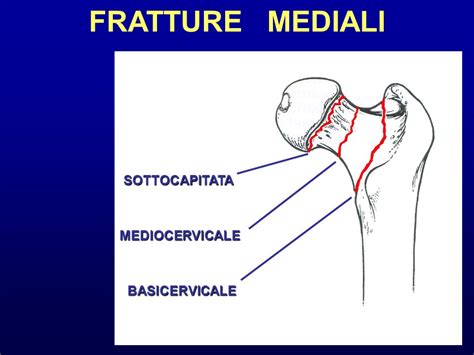 Frattura Basicervicale Femore Query Friend