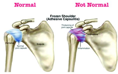 Frozen Shoulder