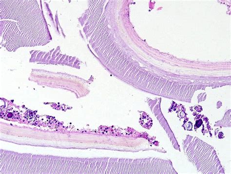 Pathology Outlines Cysts Endothelial Pseudocyst Parasitic