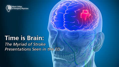 Time is Brain: The Myriad of Stroke Presentations Seen in the ED Course – ICEP Members ...