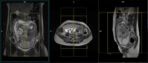 Fetal Brain MRI | Fetal Brain Scan Protocol and Planning