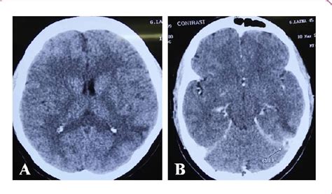 Figure 1 from Oral Contraceptive Pills Induced Vein of Labbe Thrombosis ...