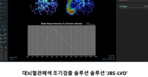 제이엘케이 “ai 뇌졸중 진단 5종 의료현장 적용”