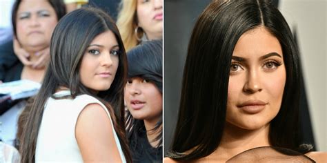 Did Kylie Jenner Have Plastic Surgery Check Out These Before And After