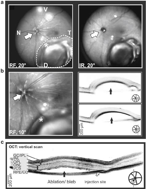 Quality Control Of The Retinal Detachment Immediately After Subretinal