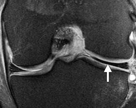 Medial Meniscus Tear Mri