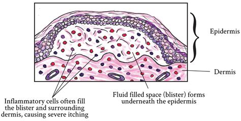 Bullous pemphigoid | MyPathologyReport.ca