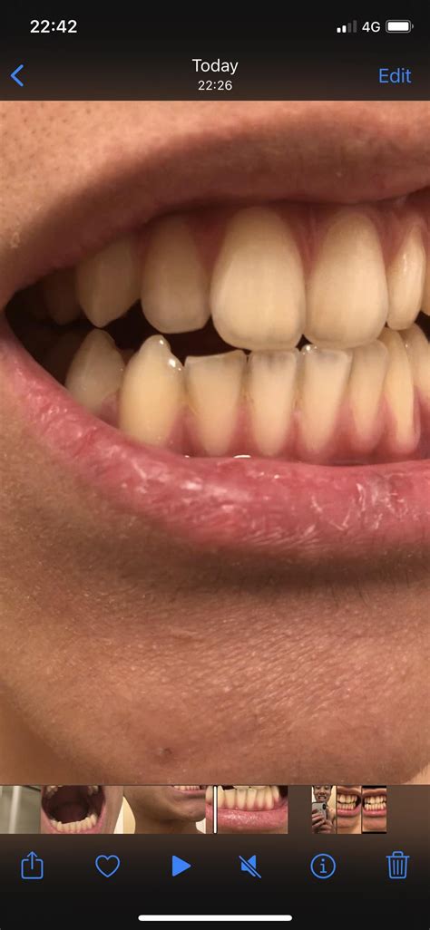 Teeth Transparency Rteethcare