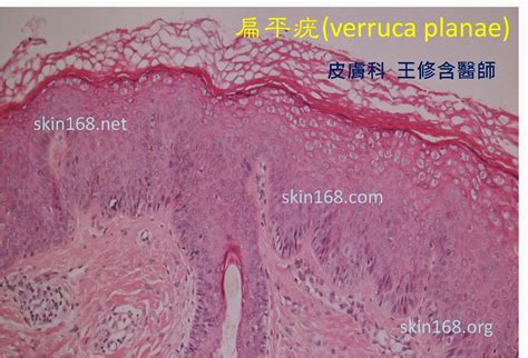 皮膚科王修含醫師 扁平疣 Verruca Planae